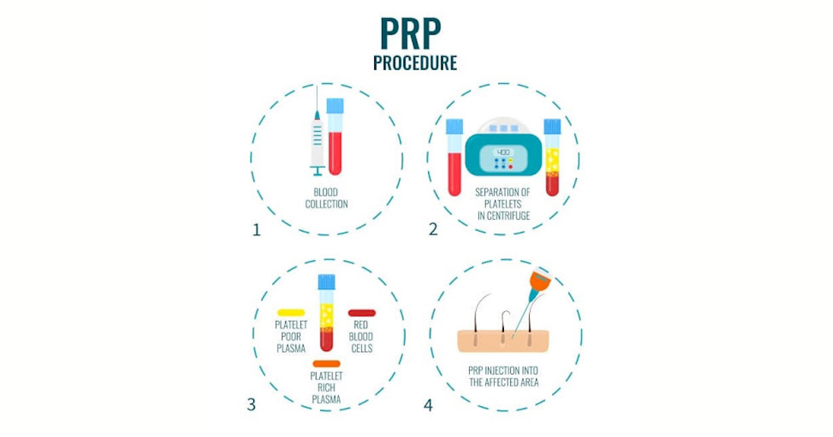 Optimal Offering Prp Therapy Bmac A Treatment Like Stem Cell Therapy - Classic Vintage Image - Ultra HD