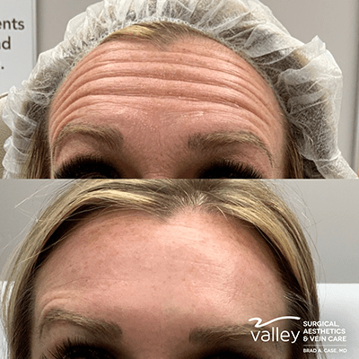 Photos showing the effects of Botox on wrinkles.