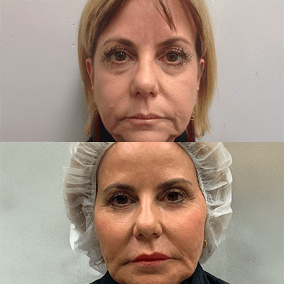 A close-up before and after photo of a woman’s face.