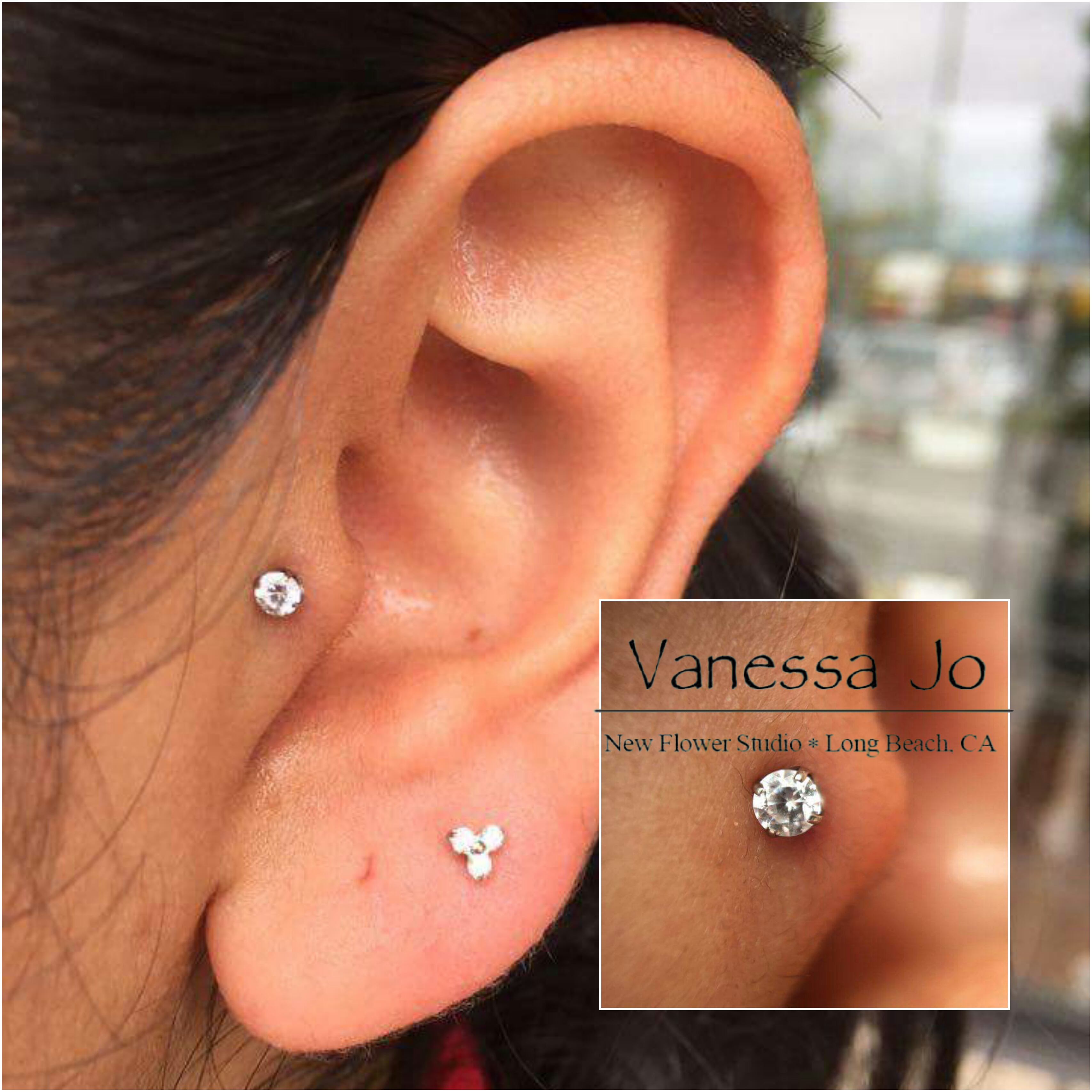 Tragus with Neometal titanium