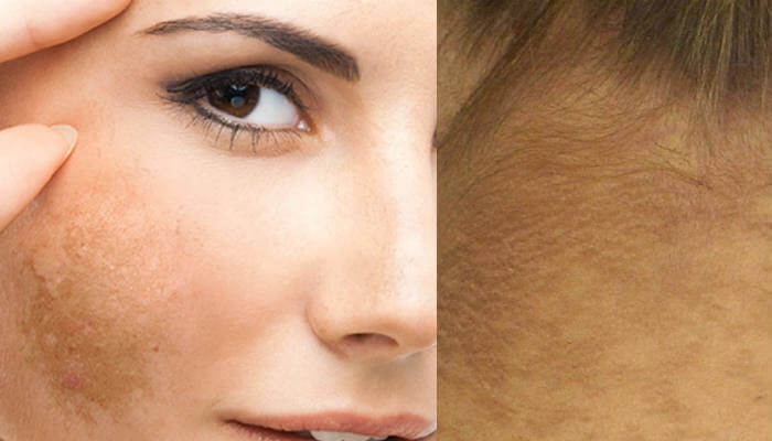 por que sale pano o melasma en la cara y piel on paño en la cara causas