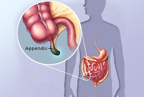 Anatomy of the ureter relevant for the laparoscopic hysterectomy in an uncomplicated. Appendicitis definition and facts | Matthew Johnson MD, FACS