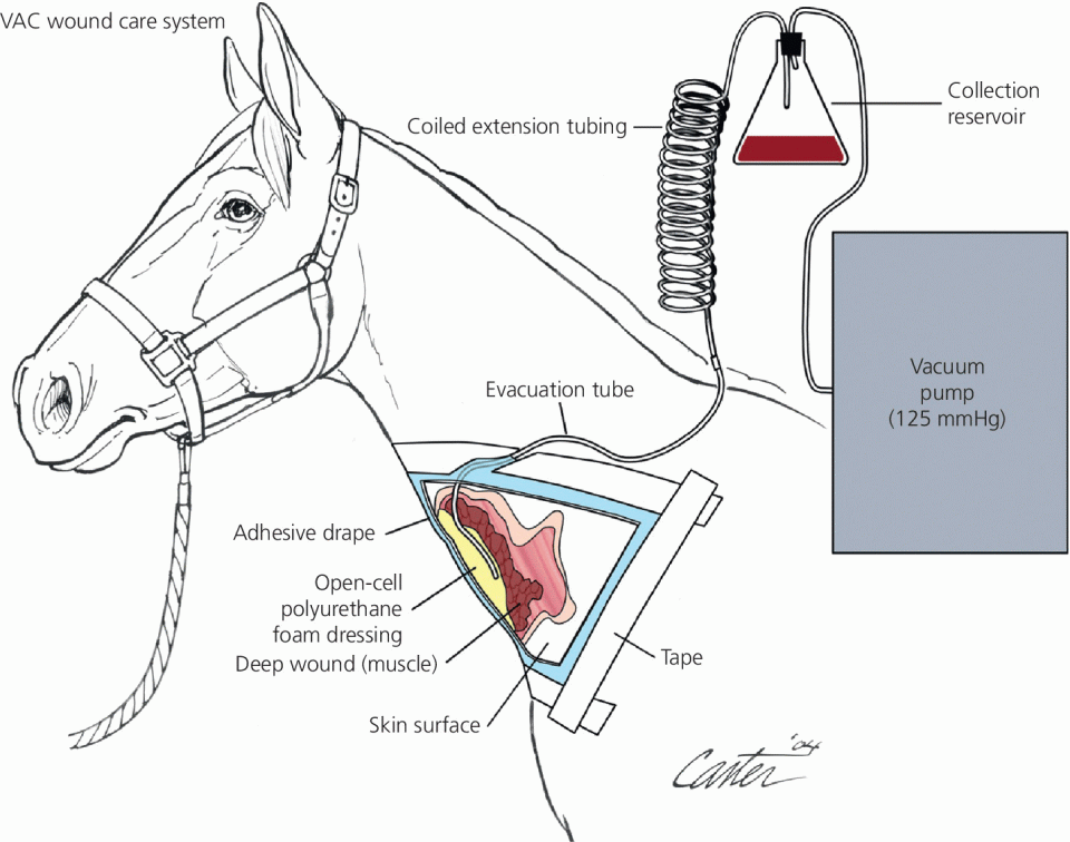 An illustration of a vacuum‐assisted closure depicting subatmospheric pressure between −75 and −125 mmHg applied to the wound using a small vacuum pump and an occlusive dressing. 