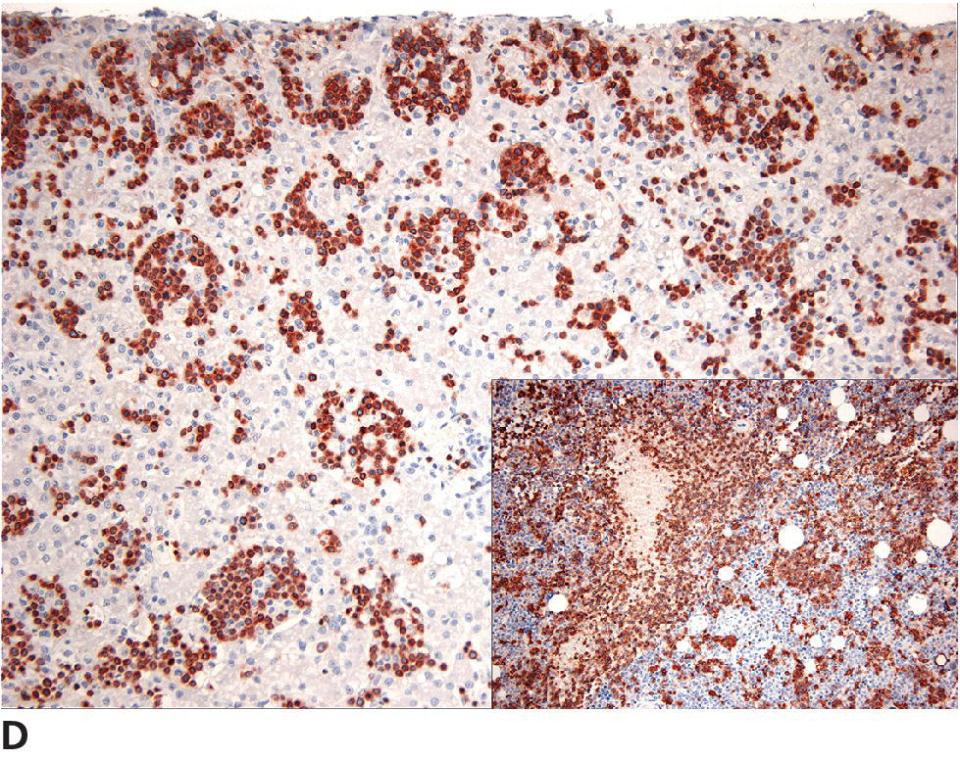 Micrograph of hepatosplenic T-cell lymphoma in a dog. CD3: Lymphoma cells in sinusoids are strongly marked. Inset: Bone marrow stained with CD11d illustrates positive staining of the tumor.