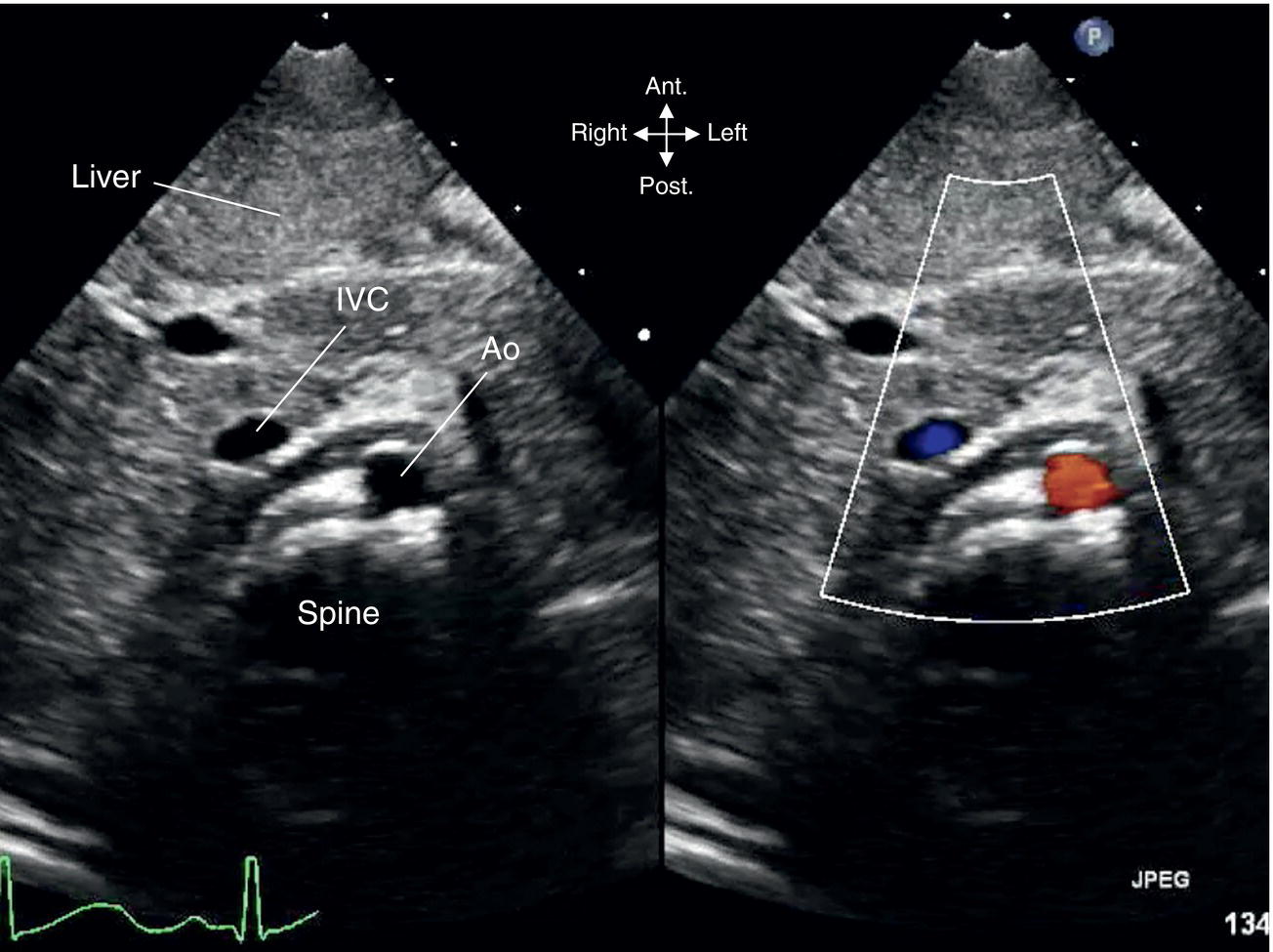 4: The Normal Pediatric Echocardiogram | Veterian Key