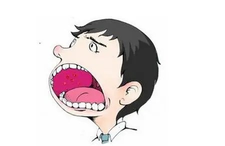 誰もが一度はかかったことのある！口内炎その原因と家庭でできる治療法