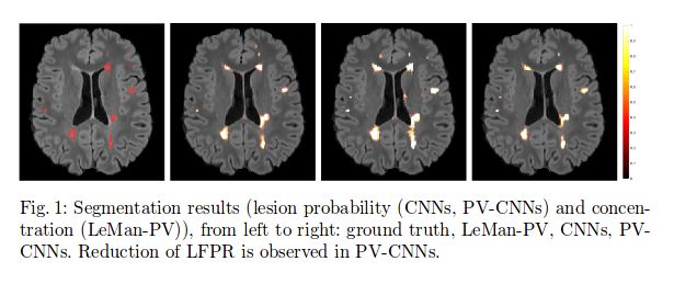 Accurate Weakly Supervised Deep Lesion Segmentation Using Large Scale - Best Light Images in Retina