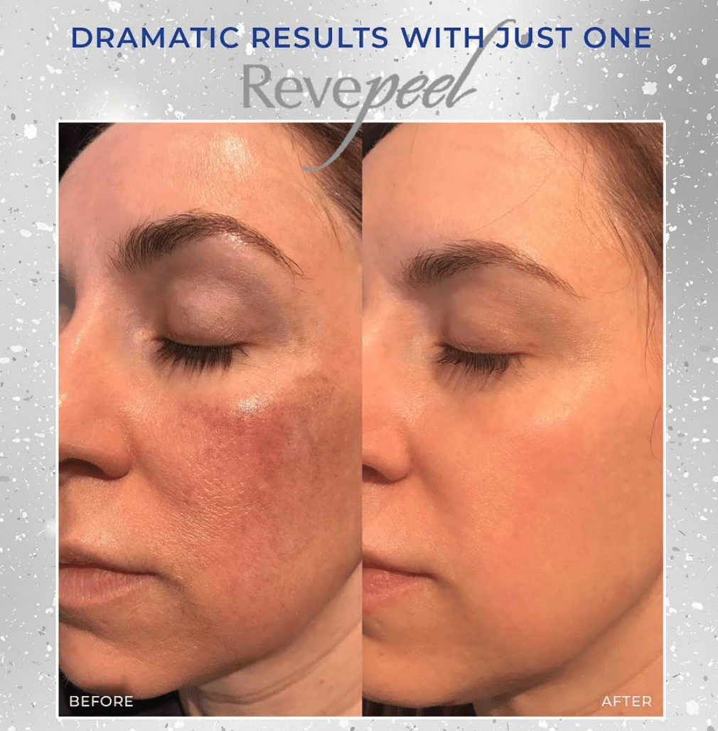enlighten rx peel near me