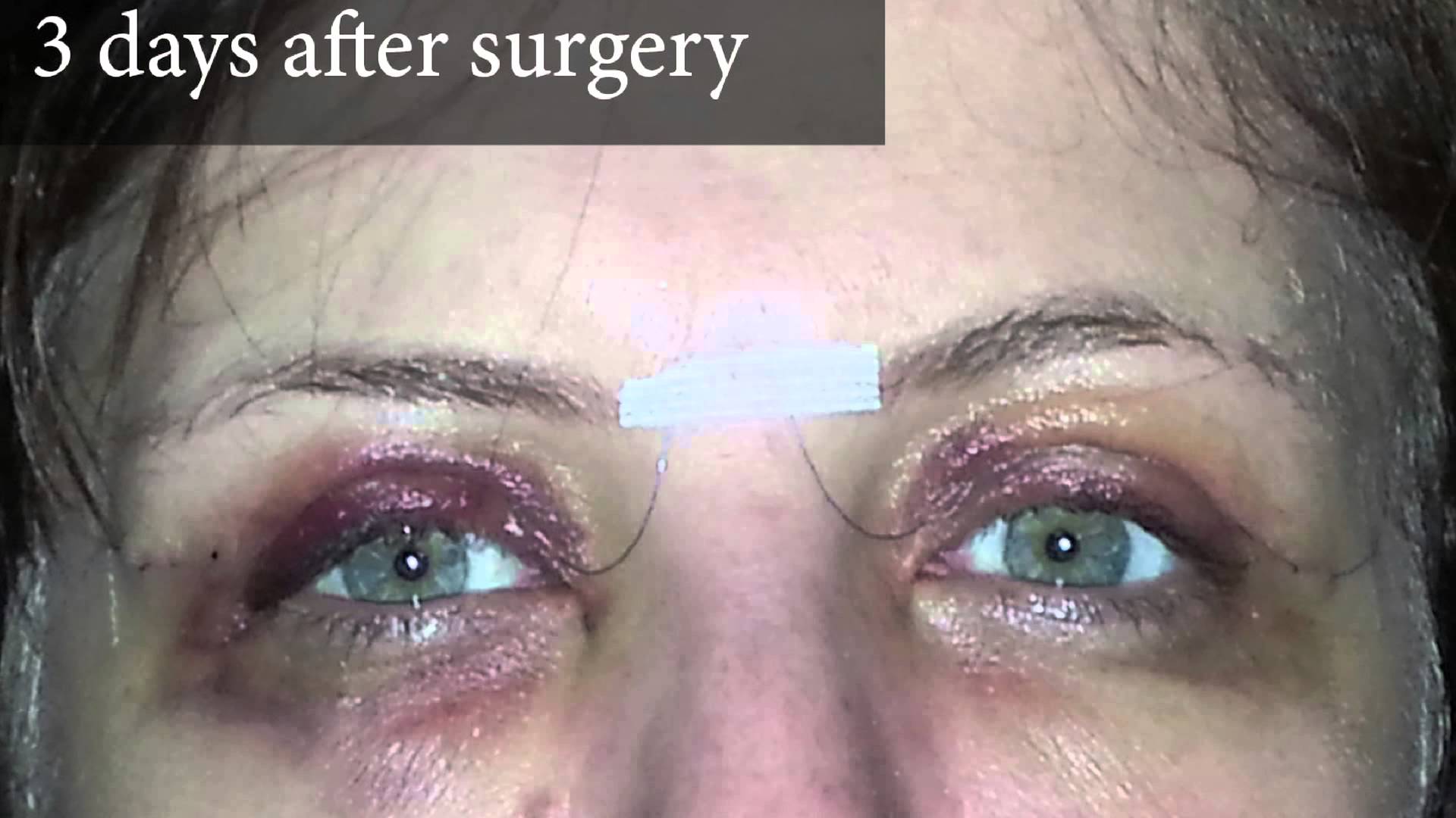 A healthy eye has a lens with clear tissue, enabling the lens to focus light onto the retina. Blepharoplasty Vs Eyelid Tightening - VoltaicPlasma