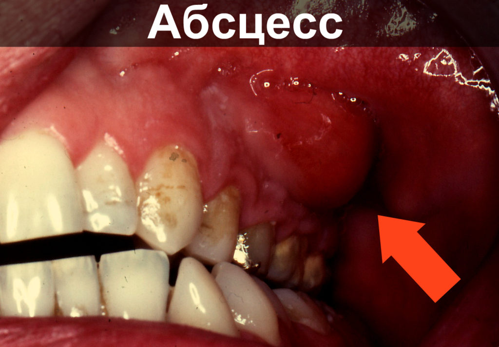 Если головная боль отдает в зубы. Может ли после удаления зуба болеть голова, отдавать в висок, ухо или шею