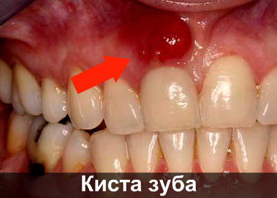 Если головная боль отдает в зубы. Может ли после удаления зуба болеть голова, отдавать в висок, ухо или шею