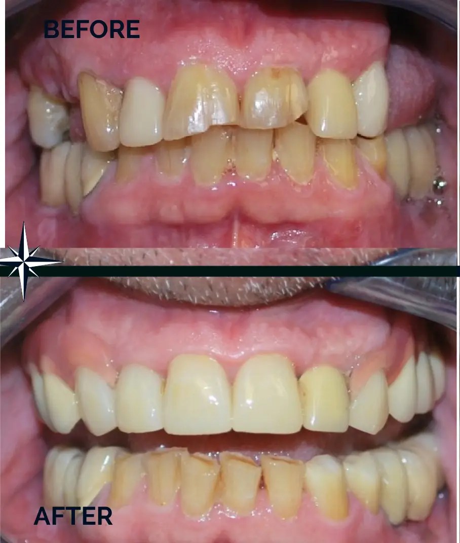denture dentist in Warren, NJ. Partial dentures replacing back worn molars.