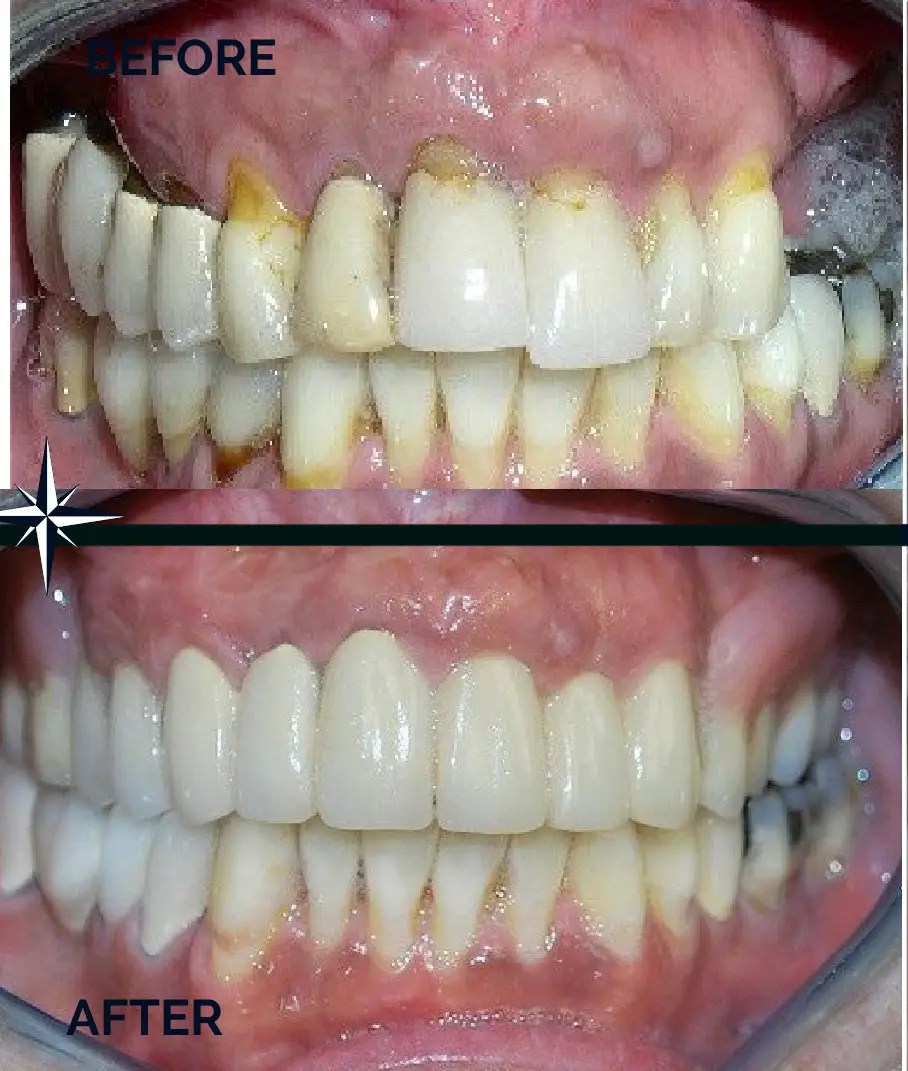 Smile solutions in Warren, NJ. Comprehensive smile reconstruction before and after