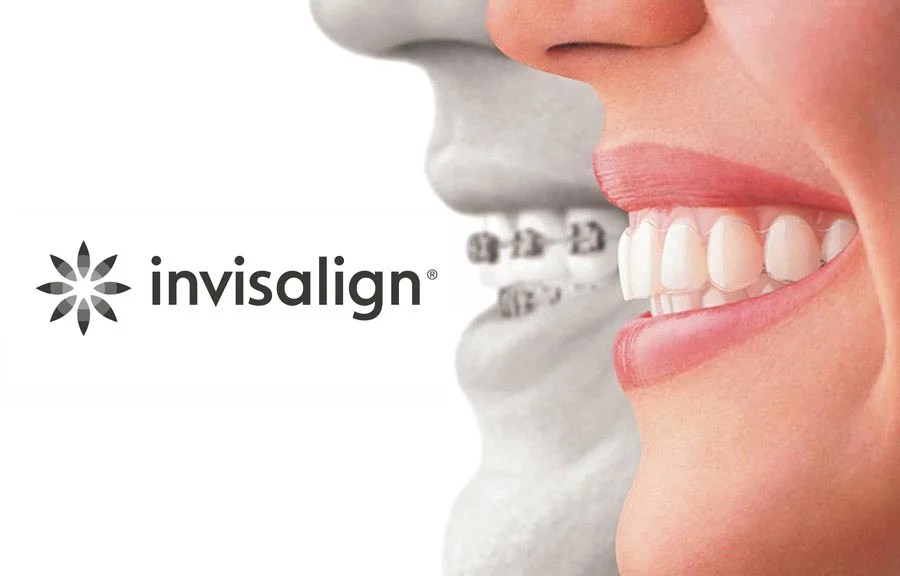 Orthodontic Appointment Invisalign