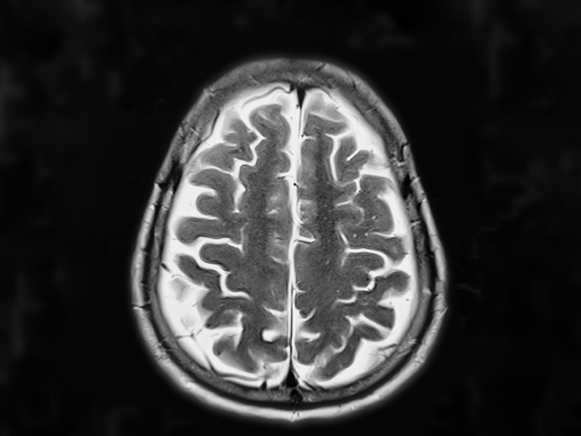 Immune Therapy for Alzheimer's: A New Hope (2026)
