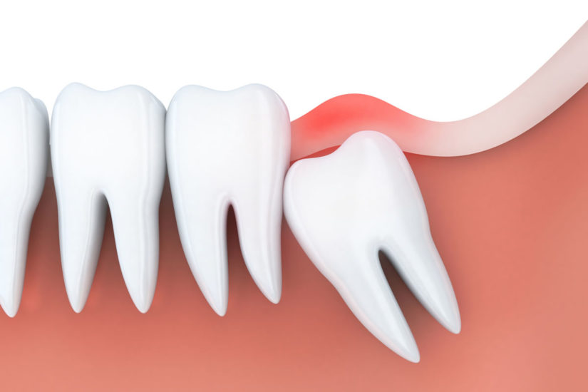 Deep tooth decay teeth with. Wisdom Teeth Removal Cost 2022 Wisdom Teeth Factory In Houston Tx