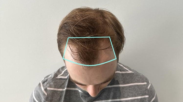 3000 grafts hair transplant l results, cost 2024