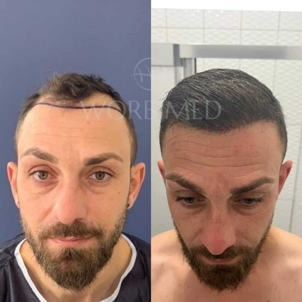 3000 grafts hair transplant l results, cost 2024