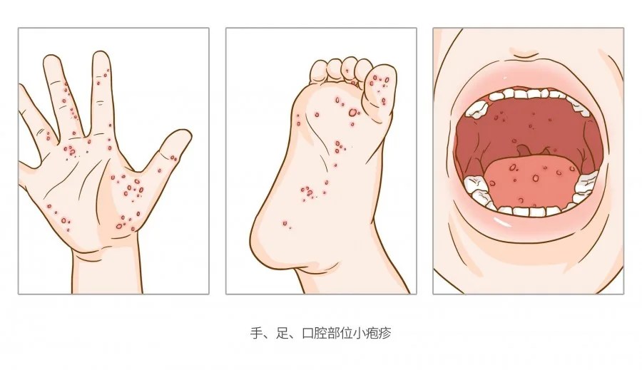 14 Most Contagious Diseases and Those That Kill the Most in Japan