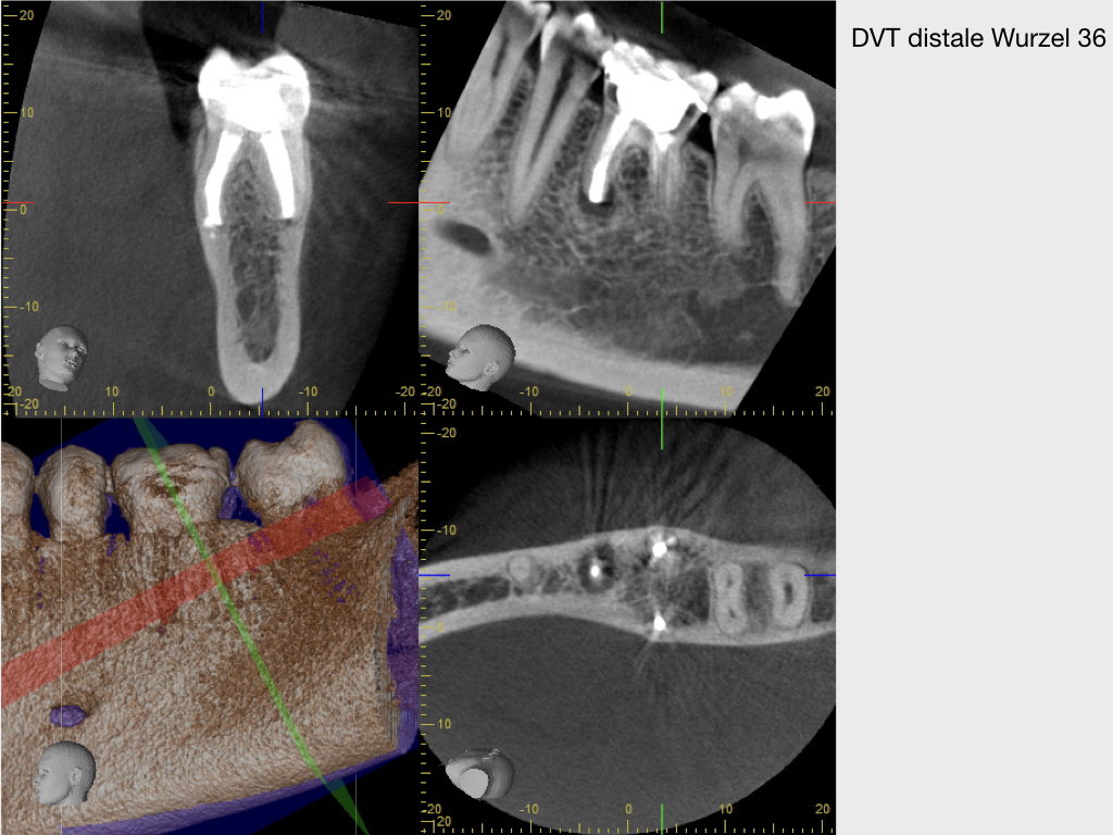 Kurz berichtet Z.n. WSR Revision mit minimalinvasivem Zugang