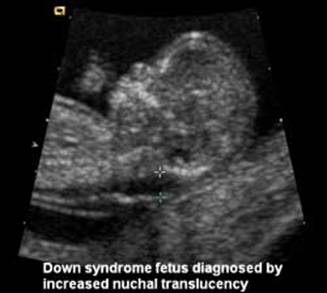 هل تظهر متلازمة داون في السونار. ØªÙØ±ÙØ± Ø¹Ù ÙØªÙØ§Ø²ÙØ© Ø¯Ø§ÙÙ ÙÙØµÙ Ø§ÙØ«Ø§ÙÙ Ø¹Ø´Ø± Ø§Ø¯Ø¨Ù