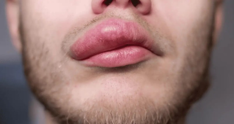 Angioedema Hereditario