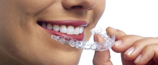 How to get free braces. Affordable Orthodontic Retainers Melbourne Free Consultation