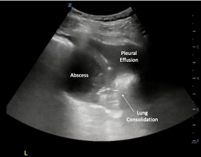 POCUS lung fig 10 lung abscess - ALiEM