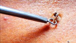 Blackhead Removal Tool: Comedone Extractor 1 Blackhead Removal Tool Comedone