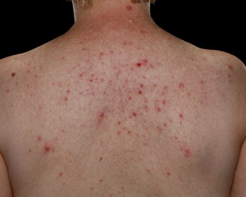 DIY Home Remedies for Back Acne Scars 1 back acne