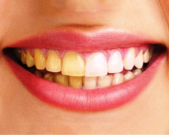 how to cure yellow teeth at home? 1 yellow between