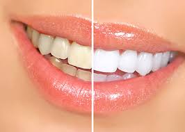 Short Overview on Teeth Whitening Treatment 1 Teeth Whitening Philadelphia