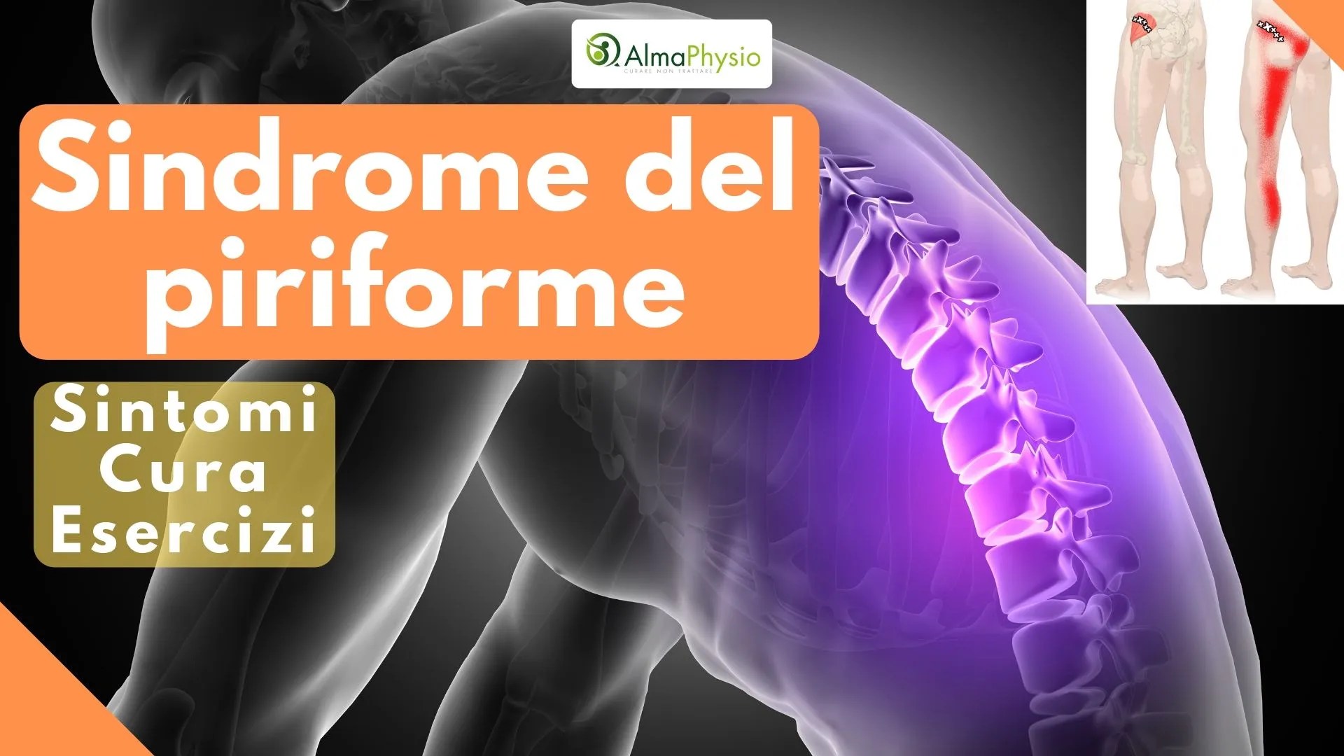 Download Gratuito immagini Sindrome Del Piriforme Sintomi Cura Esercizi Almaphysio aggiornato da parte di