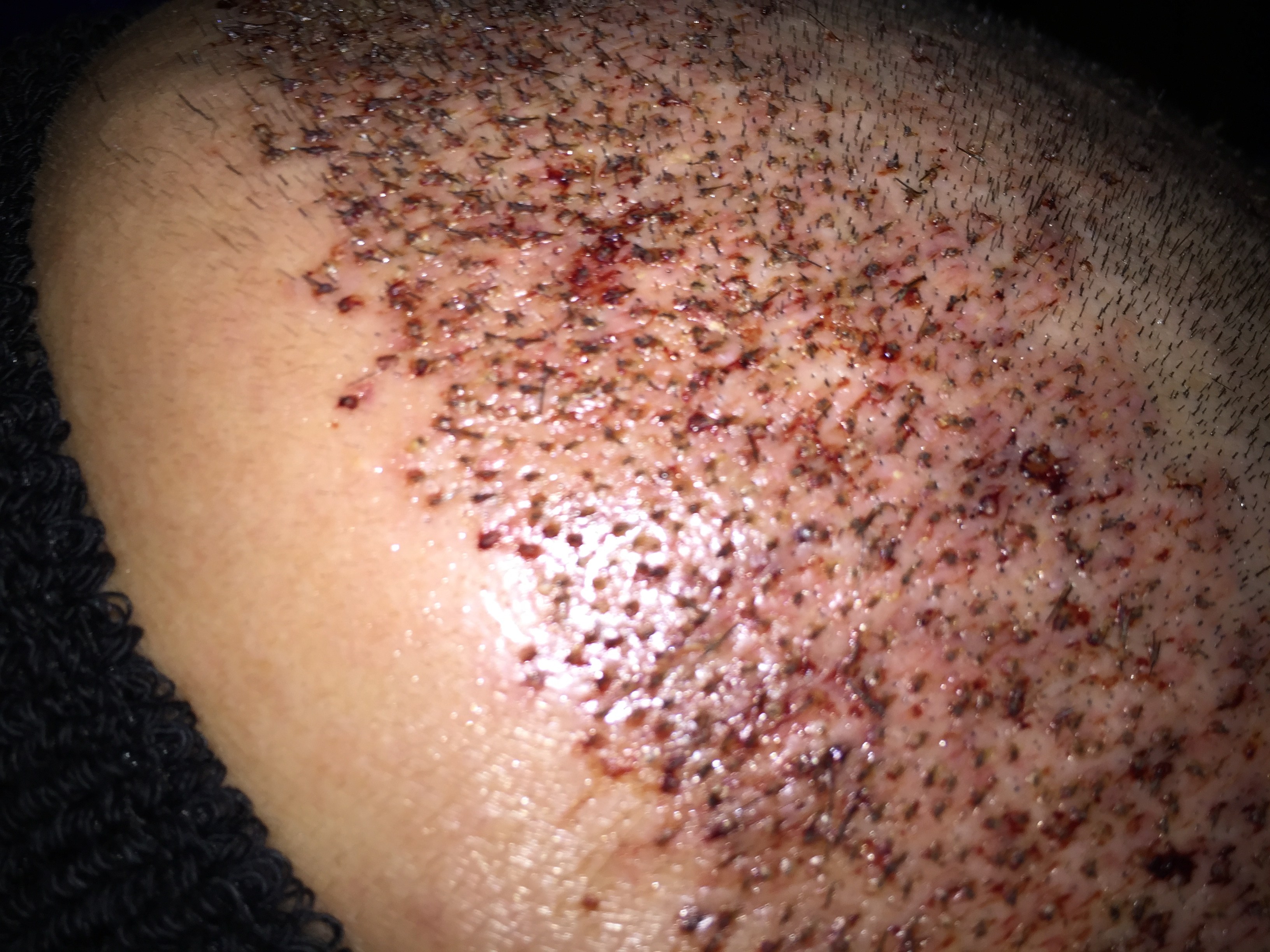 Im haartransplantation forum können sie informationen und tipps von patienten. Haartransplantation Forum : Erfahrungsberichte / Ergebnisse (nicht zugeordnet) » Meine ...