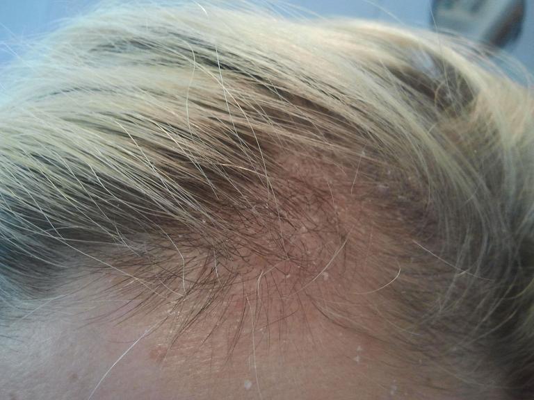 Ursachen, folgen und tipps zu schuppen finden sie hier. Haarausfall - Allgemeines Forum : Minoxidil