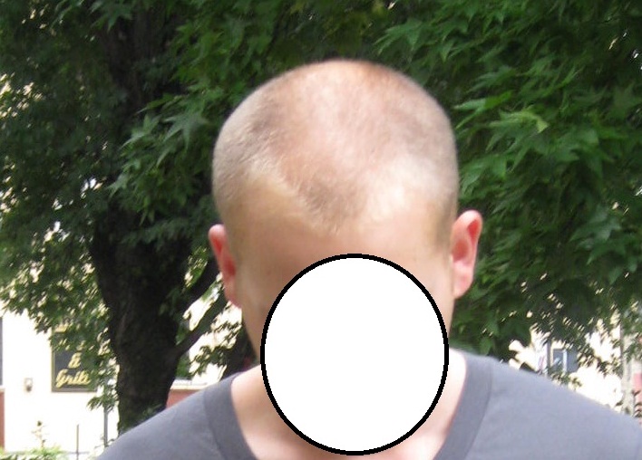 Haartransplantation für frauen in der türkei. Haarausfall - Allgemeines Forum : Allgemeines zum Thema