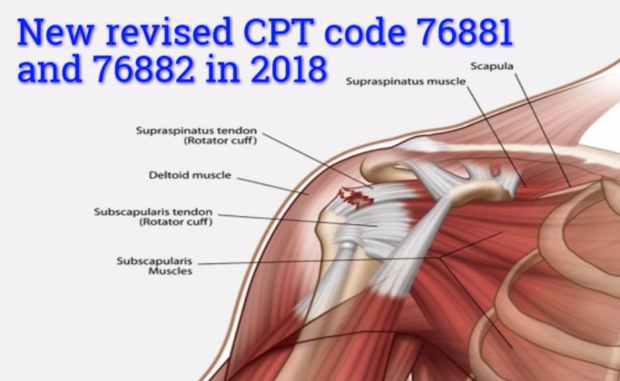 New Revised CPT code 76881 and 76882 for Extremity ultrasound