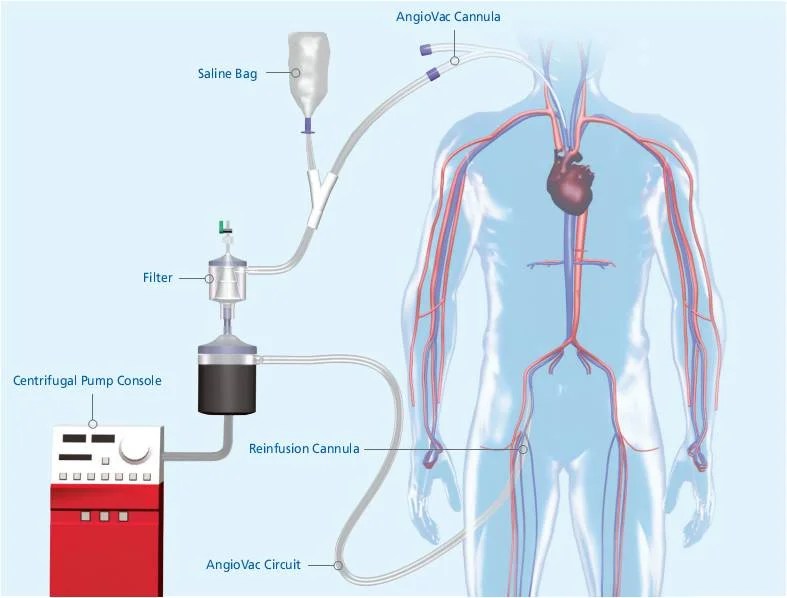 The emboli in this situation tend to be larger (including saddle emboli) . VortexÂ® for Pulmonary Embolism - Angiologist