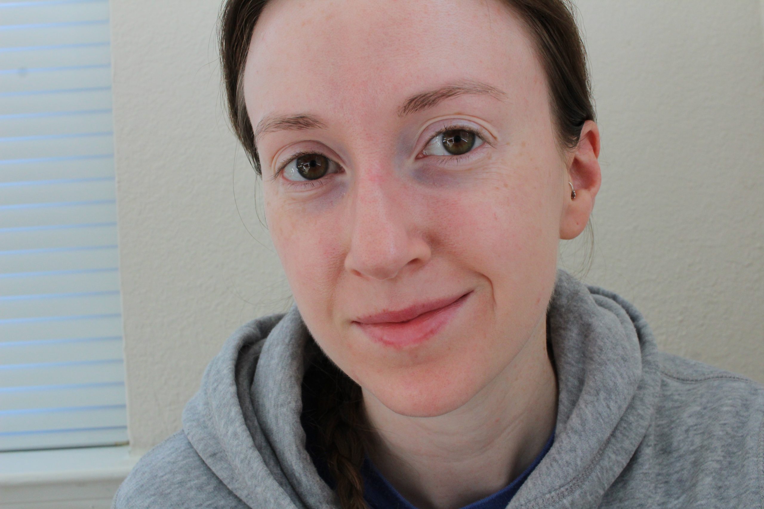 IPL Treatment Before and After