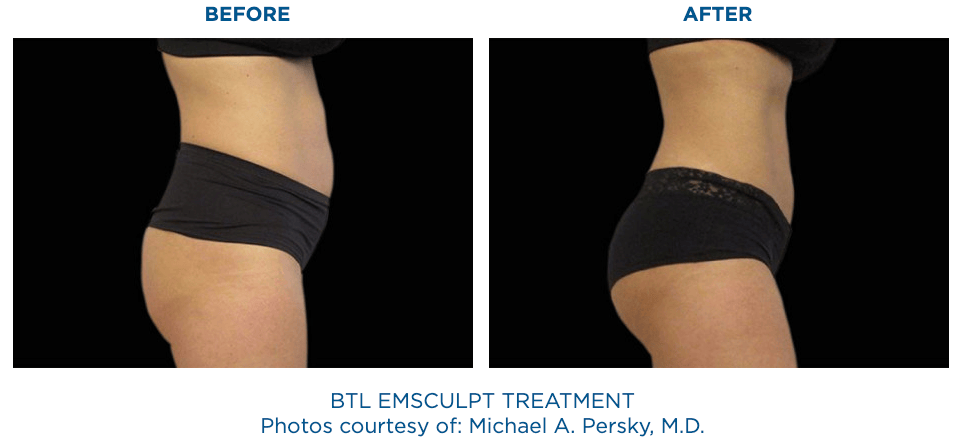 Emsculpt butt lift treatment on woman