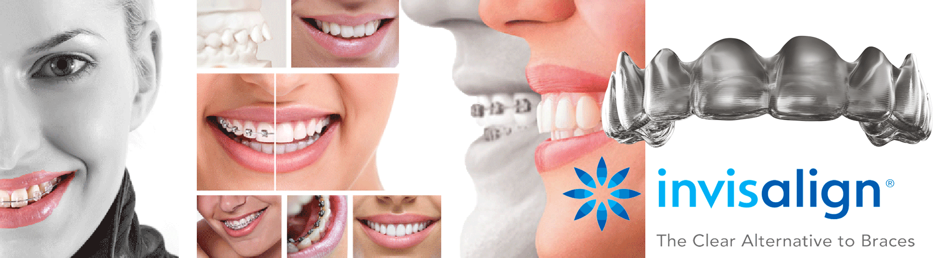 Orthodontia is free on the nhs for people up to age 18 who have a clear need for treatment. Invisalign And Orthodontics Pricing Dentist Cambridge