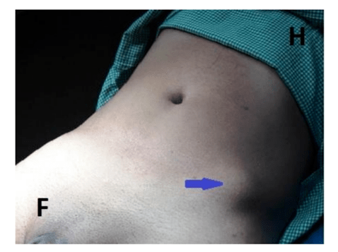 ➢ put your hand on the hips. Interspinous Line Relations With Other Landmarks Xiphisternum Umbilicus Pubic Symphysis And Arcuate Line Of Douglas And Importance For Surgeons Arc Journal Of Clinical Case Reports
