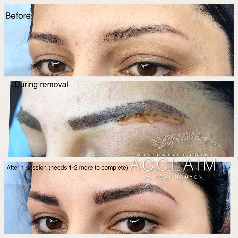 Eyebrow pencils typically range from $2 to $52. Eyebrow Tattoo Removal Arlington | Microblading Removal TX