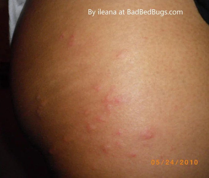 These 10 treatments for bed bu. Bed bugs bites on black people - Discussion 4