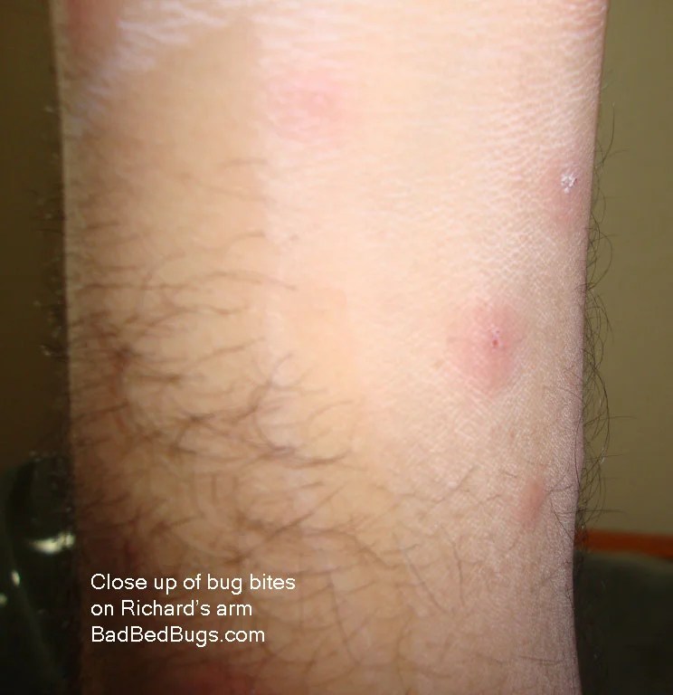 How do bed bugs get in your home? Pictures of Bed bugs bites