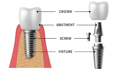Dental Implants Grand Rapids. Dr. Nithya Baker. Baker Dental Studio. General Dentist, Cosmetic Dentist, Restorative Dentist, Preventative Dentist, Family Dentist. SureSmile, Family Dentistry(Pediatric Dentistry), teeth Whitening, 3D Scanner. Dental Studio in Grand Rapids, MI 49546
