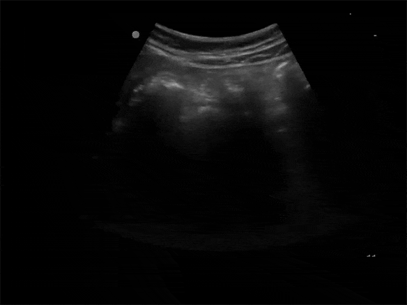 Learn all four quadrants of a coordinate system. Bowel Obstruction | BCPoCUS
