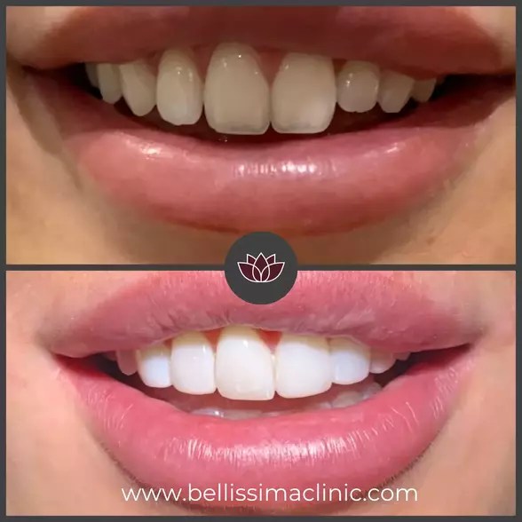 Teeth Whitening Before & after 2