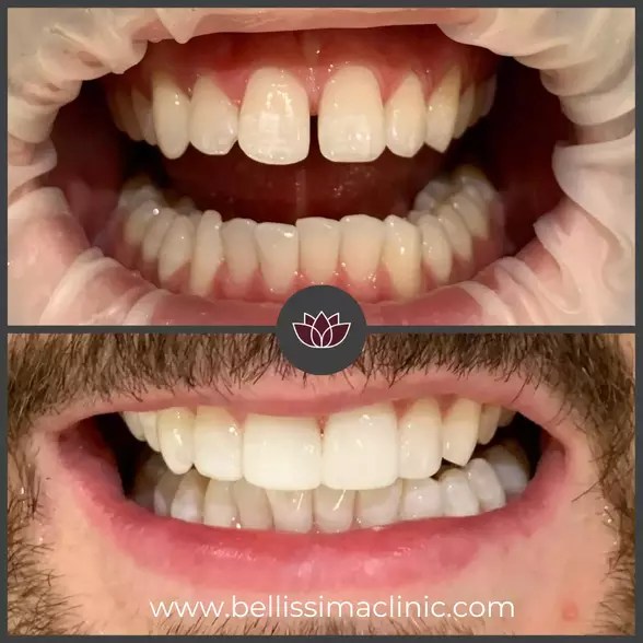 Mini Smile Make Over Before & After 1 Solihull