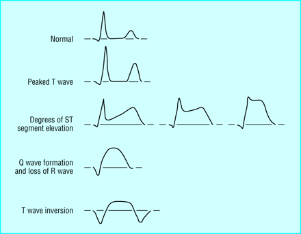 picture Myocardial Infarction Ecg Tracing the bmj